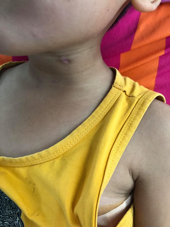 Anh 9 tuổi nghịch súng cướp cò bắn xuyên cổ em trai 6 tuổi