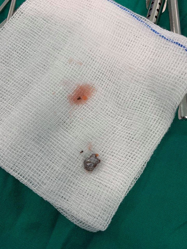 Anh 9 tuổi nghịch súng cướp cò bắn xuyên cổ em trai 6 tuổi