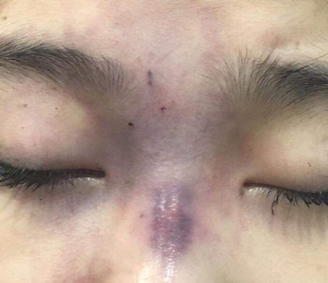 Chồng sắp cưới mua filler tiêm nâng mũi cho vợ khiến cô gái bị mù vĩnh viễn