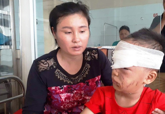 Bé trai 6 tuổi ở Thanh Hóa bị chó nhà cắn rách mặt
