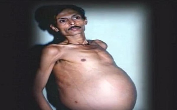 Người đàn ông đầu tiên mang thai trên thế giới và câu chuyện bí ẩn phía sau