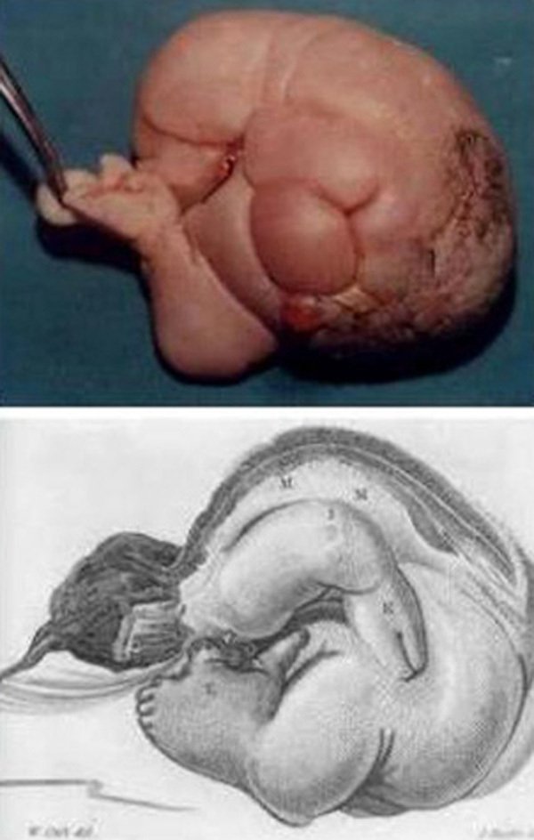 Người đàn ông đầu tiên mang thai trên thế giới và câu chuyện bí ẩn phía sau