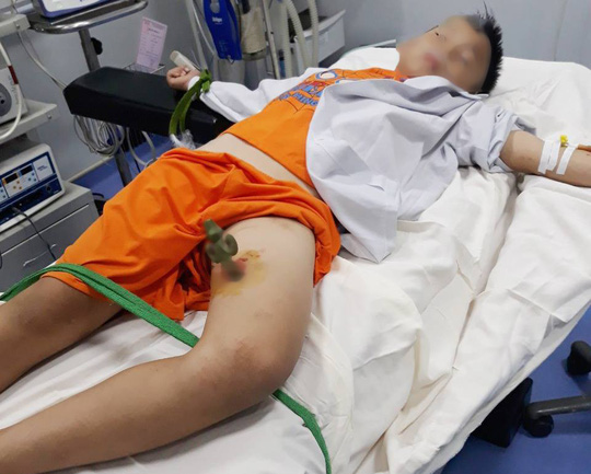 Cưa mũi nhọn sắt hàng rào cắm vào đùi, đưa bé trai đi cấp cứu
