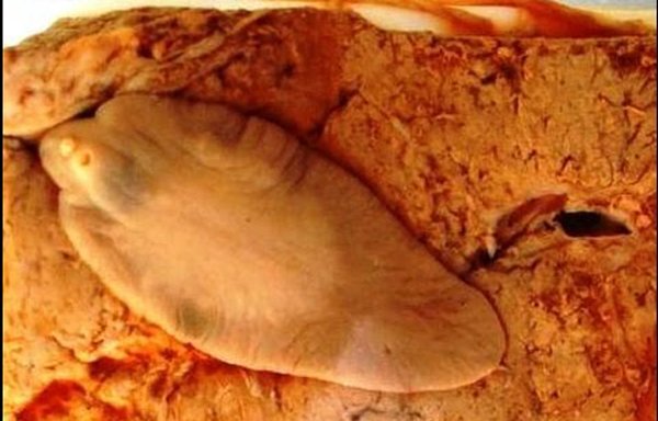 Tưởng mụn ở ngực, cô gái Sơn La nặn ra con sán ngoe nguẩy