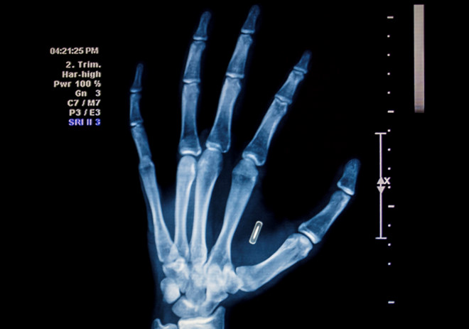 Cấy chip vào người sống - trào lưu đang nổi lên toàn cầu