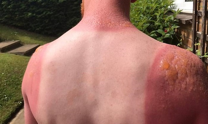 Uống 5 loại thuốc không rõ nguồn gốc, bệnh nhân mắc chứng cứ ra nắng là bỏng da