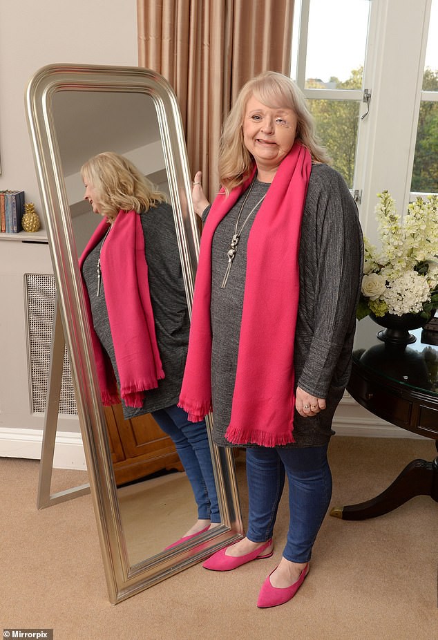 Người phụ nữ bị vi khuẩn ăn hết nửa khuôn mặt: Đừng chủ quan dù chỉ có một vết xước nhỏ!