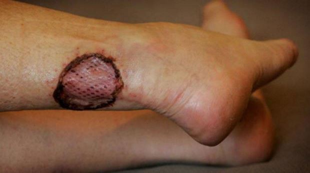 Người phụ nữ bị vi khuẩn ăn hết nửa khuôn mặt: Đừng chủ quan dù chỉ có một vết xước nhỏ!