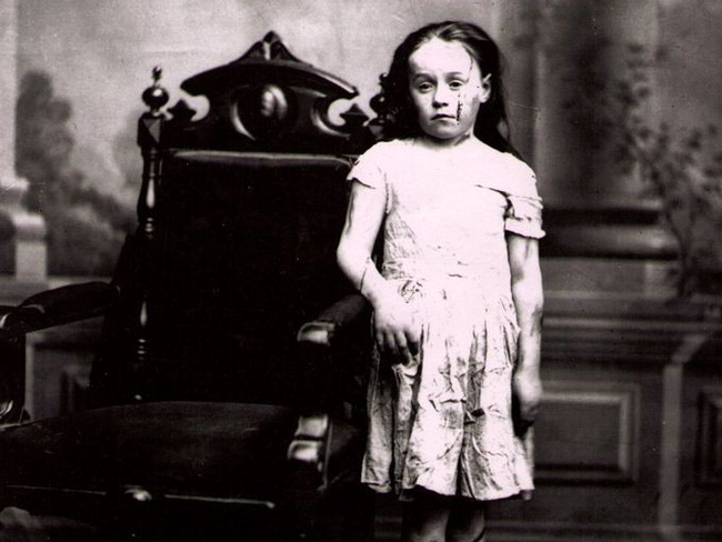 Cuộc sống địa ngục của Mary Ellen Wilson, nạn nhân đầu tiên từng được ghi nhận của nạn bạo hành trẻ em đã khiến luật pháp Mỹ phải thay đổi