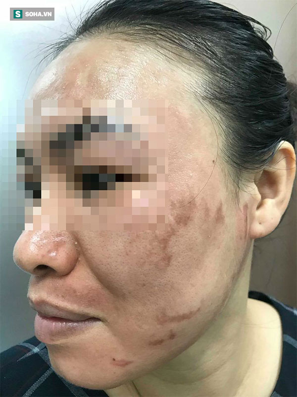 Chi cả trăm triệu làm đẹp mặt vẫn biến dạng, nhiều quý bà phải cầu cứu bác sĩ