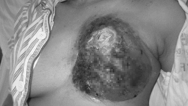 Ung thư vú tại Việt Nam liên tục tăng, khuyến cáo đặc biệt của Giám đốc BV K