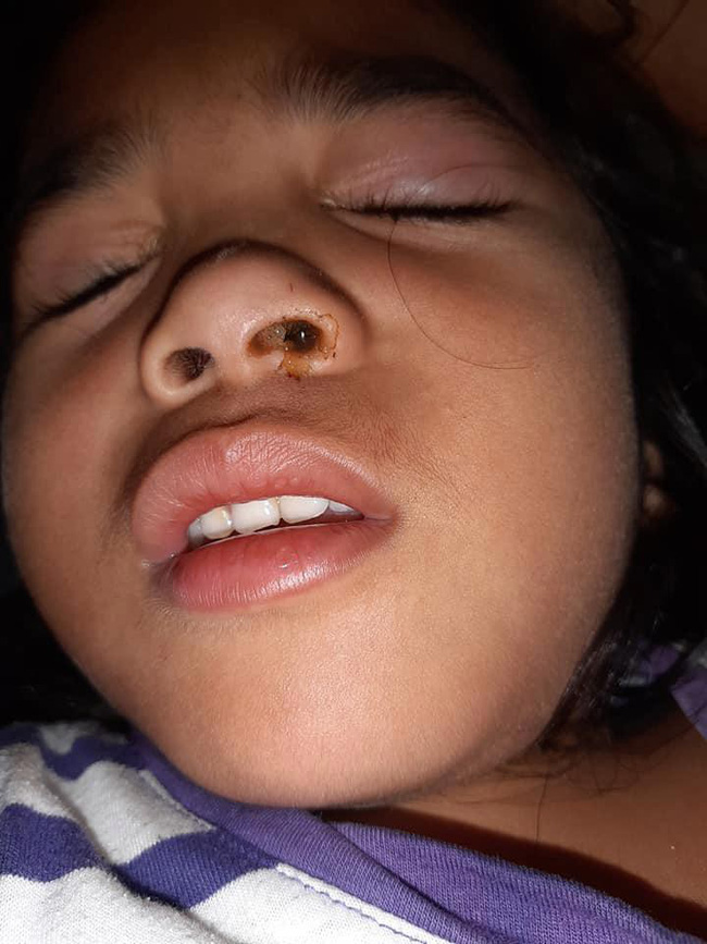 Con gái kêu đau đầu, mẹ nghi con bị dị ứng, tự tiện mua thuốc giảm đau nhưng rồi ngã quỵ khi bác sĩ lấy ra thứ kinh dị này