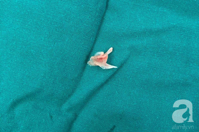 Cắn bút khi ngồi trong lớp, bé gái 7 tuổi ở TP.HCM suýt chết vì nuốt ruột bút chì vào phổi