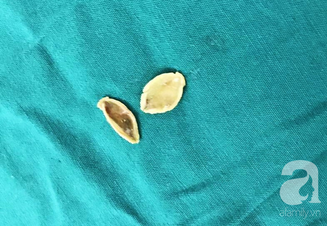 Cắn bút khi ngồi trong lớp, bé gái 7 tuổi ở TP.HCM suýt chết vì nuốt ruột bút chì vào phổi