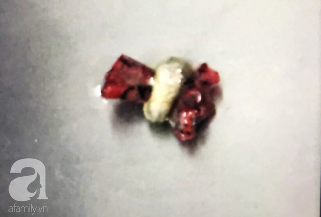 Cắn bút khi ngồi trong lớp, bé gái 7 tuổi ở TP.HCM suýt chết vì nuốt ruột bút chì vào phổi