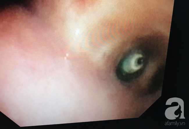 Cắn bút khi ngồi trong lớp, bé gái 7 tuổi ở TP.HCM suýt chết vì nuốt ruột bút chì vào phổi