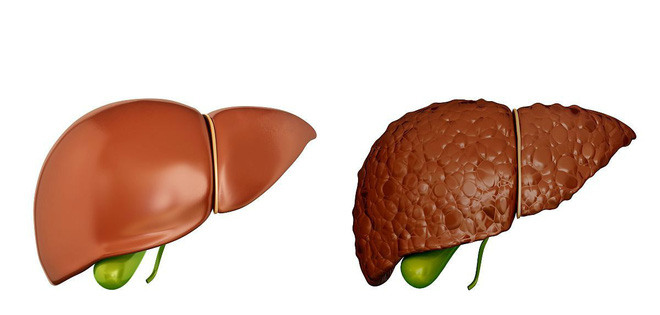 Khi có sự thay đổi này xảy ra ở ngực: 90% khả năng bạn đã bị xơ gan, hãy nhanh đi khám