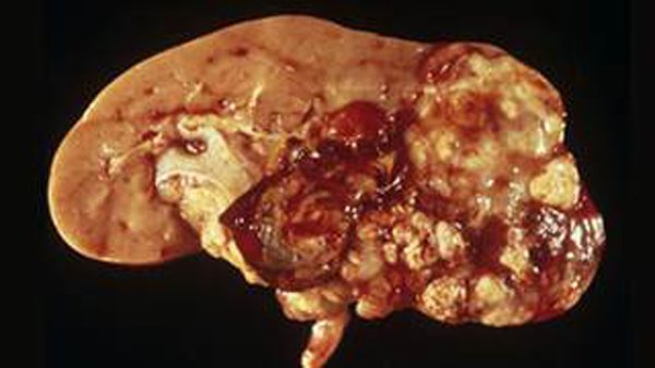 Những điều ít biết về căn bệnh ung thư thận diễn viên Ngọc Căn mắc phải