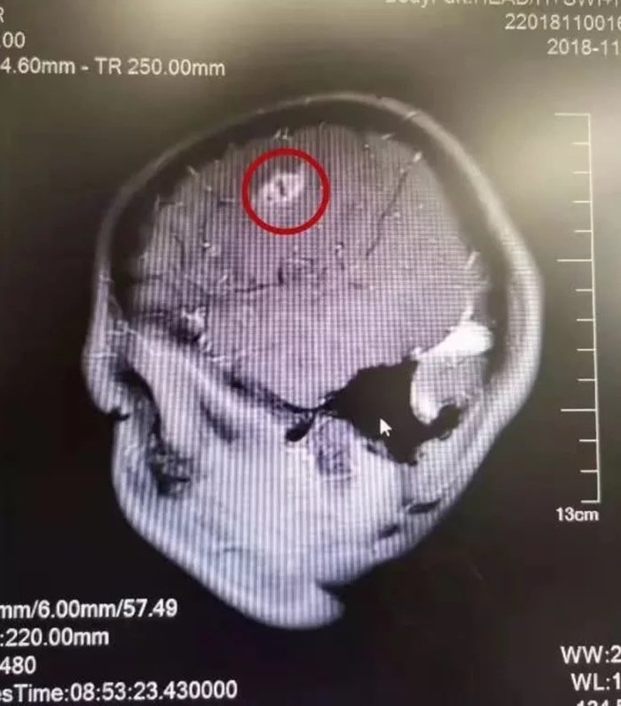 Bác sĩ lôi ký sinh trùng 15cm trong não bé trai, cảnh báo thói quen xấu khi ăn uống