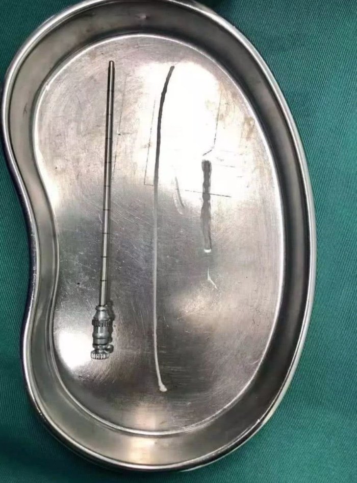 Bác sĩ lôi ký sinh trùng 15cm trong não bé trai, cảnh báo thói quen xấu khi ăn uống