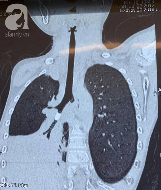 Long An: Ném cát đùa giỡn với bạn, bé trai 6 tuổi hít phải miếng nhựa vào mũi gây xẹp phổi nguy kịch