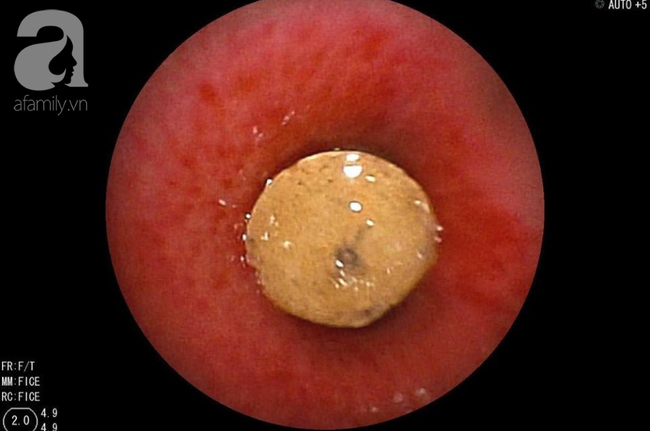 Long An: Ném cát đùa giỡn với bạn, bé trai 6 tuổi hít phải miếng nhựa vào mũi gây xẹp phổi nguy kịch