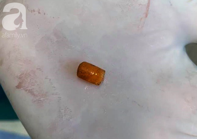 Long An: Ném cát đùa giỡn với bạn, bé trai 6 tuổi hít phải miếng nhựa vào mũi gây xẹp phổi nguy kịch