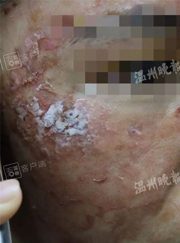 Dùng mặt nạ mua qua mạng, cô gái 25 tuổi bị biến dạng khuôn mặt: Lời cảnh tỉnh cho tất cả chị em