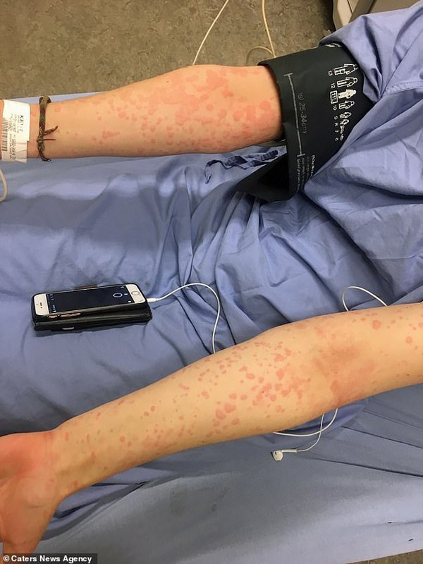 Cô gái nổi tiếng vì dị ứng mùa đông, bác sĩ lắc đầu trước bệnh hiếm