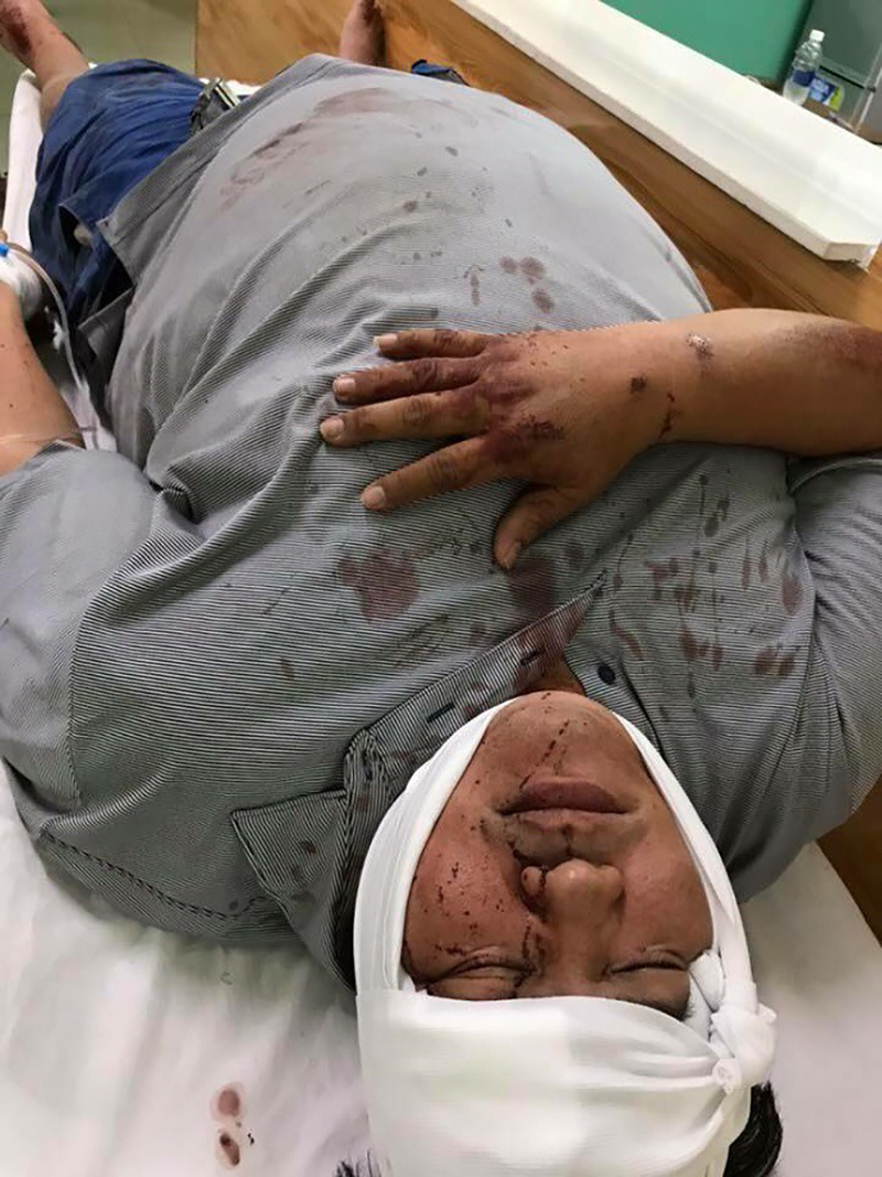 Trước khi gặp tai nạn nghiêm trọng, Hoàng Mập nhiều lần nằm mơ điều đáng sợ