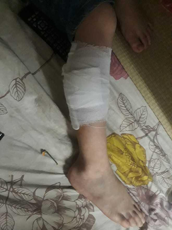 Hà Nội: Đang chơi trong ngõ, bé trai bị đàn 4 con chó lao ra cắn