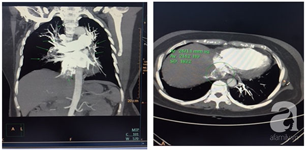 Mắc căn bệnh sát nhân thầm lặng gần như không có triệu chứng cụ thể, người phụ nữ được cứu sống sau 11 tiếng