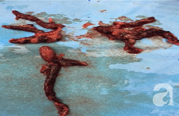 Mắc căn bệnh sát nhân thầm lặng gần như không có triệu chứng cụ thể, người phụ nữ được cứu sống sau 11 tiếng