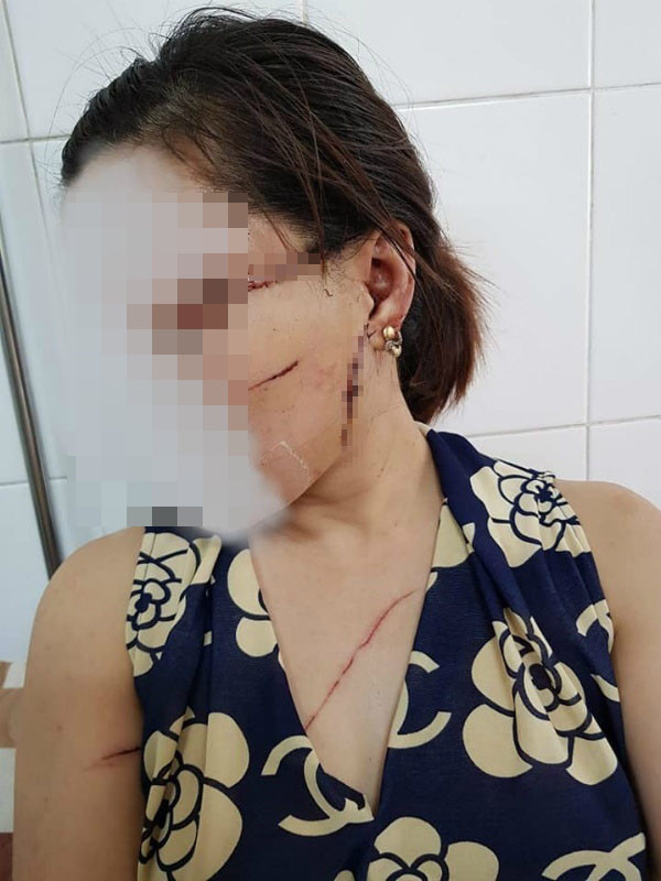 Gã chồng cắt gân chân vợ do ghen tuông lĩnh 27 tháng tù