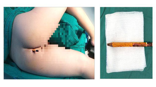 Ớn lạnh hình ảnh bé trai bị bị bút chì đâm thấu mông đến 8 cm