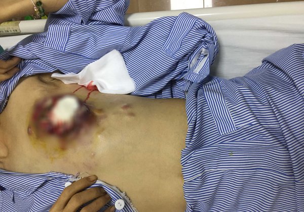 Mắc ung thư vú giai đoạn sớm, chỉ vì cả tin người phụ nữ lĩnh hậu quả nặng nề