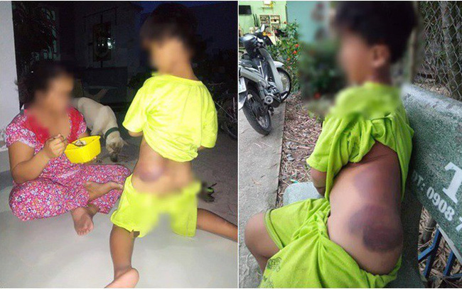 Mẹ học sinh lớp 1 khuyết tật bị giáo viên đánh bầm tím người: Đừng đuổi việc cô, do cô thương nên mới đánh bé