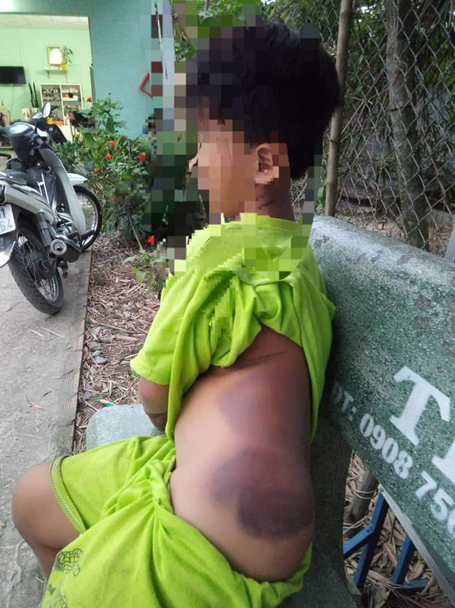 Long An: Bé trai khuyết tật học lớp 1 bị cô giáo đánh bầm tím khắp người