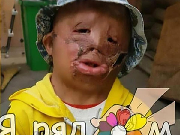 Cậu bé 5 tuổi viết thư xin ông già Noel một khuôn mặt mới