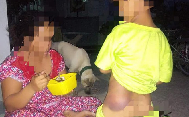 Vụ bé trai tật nguyền bị cô giáo đánh bầm tím người: Cô giáo đến nhà xin lỗi