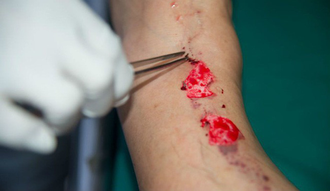 Người đàn ông 34 tuổi bị đau hậu môn, nào ngờ suýt mất mạng vì mắc căn bệnh hiếm gặp