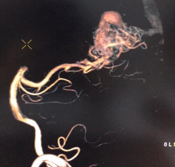 Chủ quan với cơn đau đầu bạn có nguy cơ đột quỵ ở tuổi 20