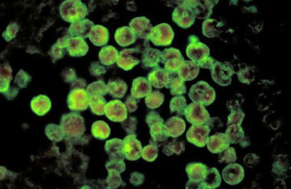 Người phụ nữ tử vong do bị amip ăn não người tấn công sau khi dùng bình rửa mũi