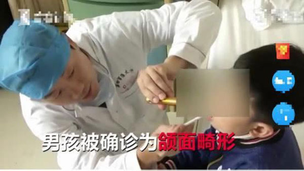 Bé trai 5 tuổi không thể ngậm được miệng, bị chẩn đoán mắc dị tật xương hàm vì thói quen của trẻ mà hầu hết phụ huynh đều bỏ qua