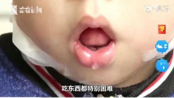 Bé trai 5 tuổi không thể ngậm được miệng, bị chẩn đoán mắc dị tật xương hàm vì thói quen của trẻ mà hầu hết phụ huynh đều bỏ qua