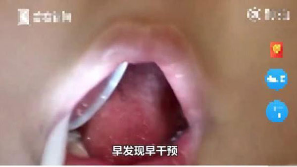 Bé trai 5 tuổi không thể ngậm được miệng, bị chẩn đoán mắc dị tật xương hàm vì thói quen của trẻ mà hầu hết phụ huynh đều bỏ qua