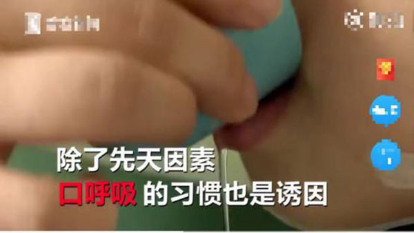 Bé trai 5 tuổi không thể ngậm được miệng, bị chẩn đoán mắc dị tật xương hàm vì thói quen của trẻ mà hầu hết phụ huynh đều bỏ qua