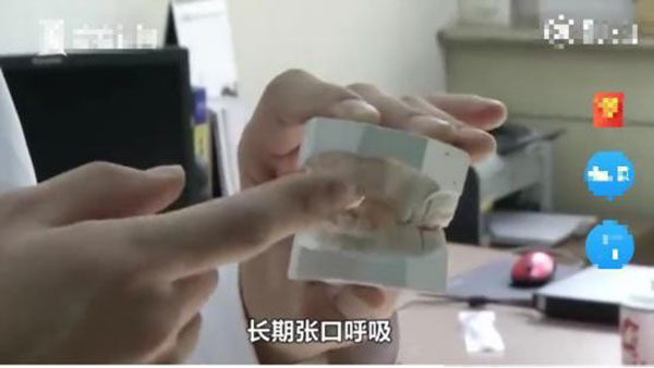 Bé trai 5 tuổi không thể ngậm được miệng, bị chẩn đoán mắc dị tật xương hàm vì thói quen của trẻ mà hầu hết phụ huynh đều bỏ qua