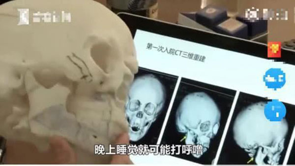 Bé trai 5 tuổi không thể ngậm được miệng, bị chẩn đoán mắc dị tật xương hàm vì thói quen của trẻ mà hầu hết phụ huynh đều bỏ qua