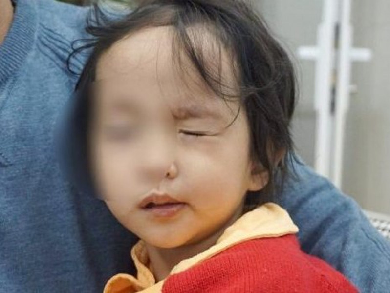 Trời rét đậm, rét hại, nhiều trẻ bị liệt mặt, méo miệng